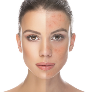 dermis acne image