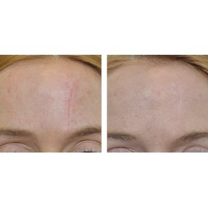 scar-removal-before-and-after