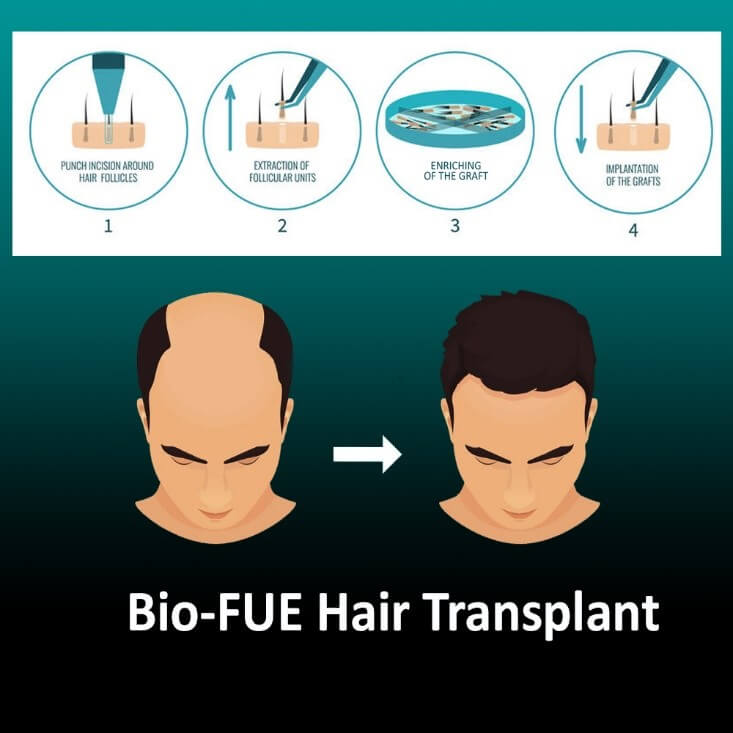 Bio-FUE Hair Transplant