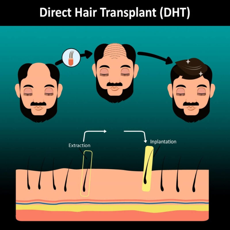 Direct hair transplant (DHT)