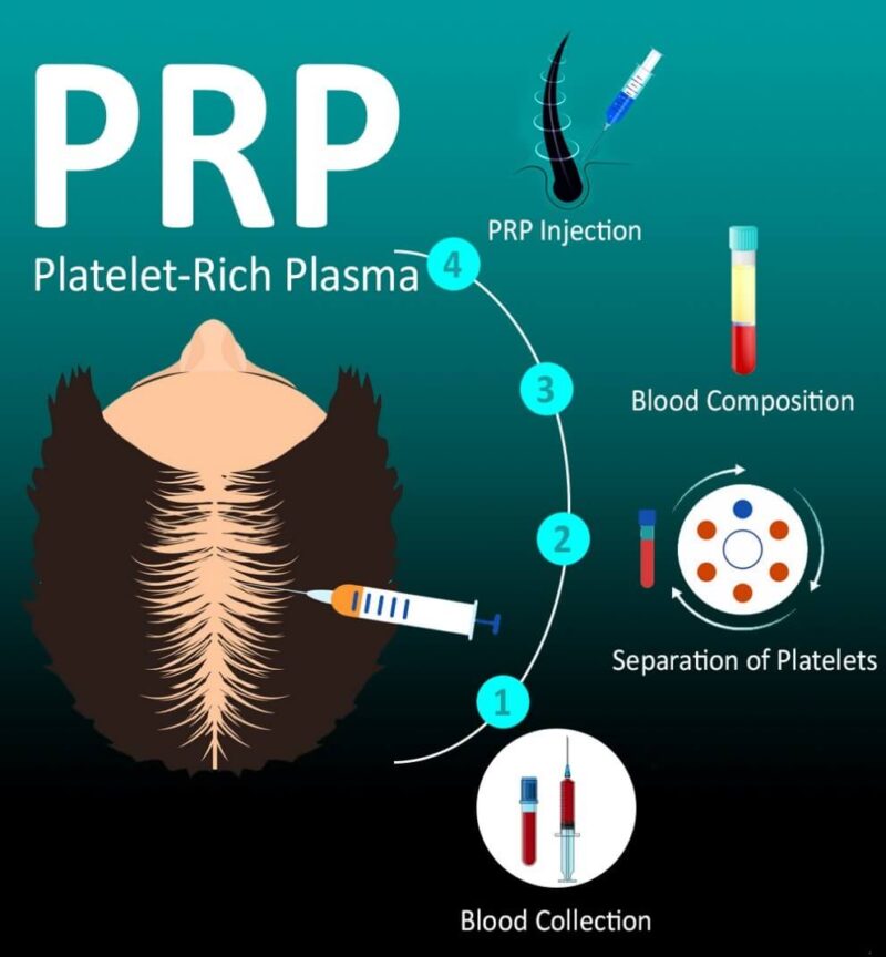 PRP treatment