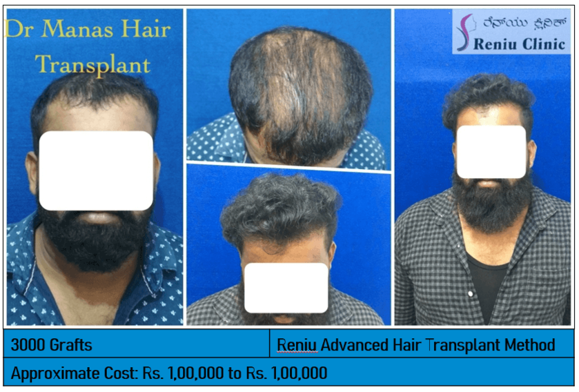 Best Hair Transplant in Mysore – View Results | Reniu Clinic