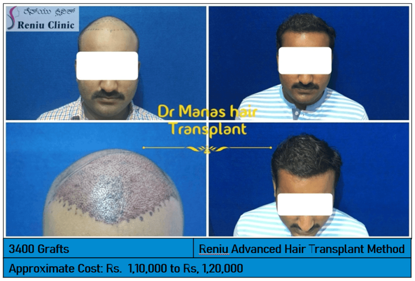 Best Hair Transplant in Mysore – View Results | Reniu Clinic