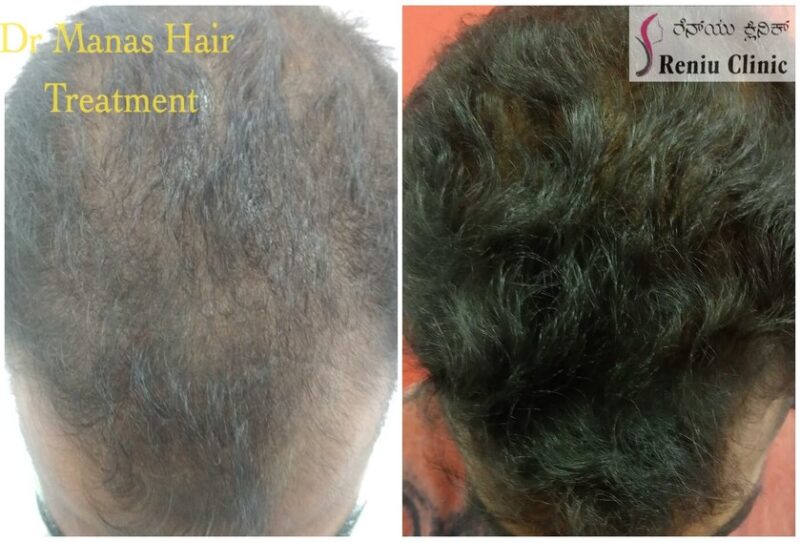Dr Manas Jain Hair treatment