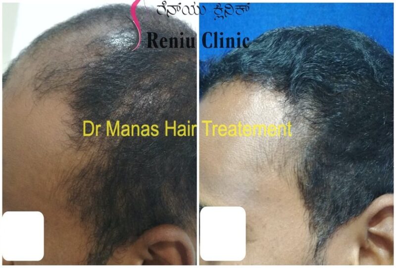 Dr Manas Jain Hair treatment