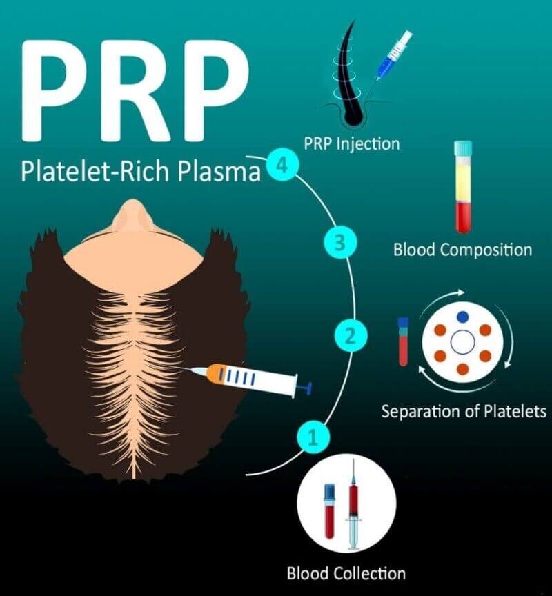 Platelet-rich Plasma treatment