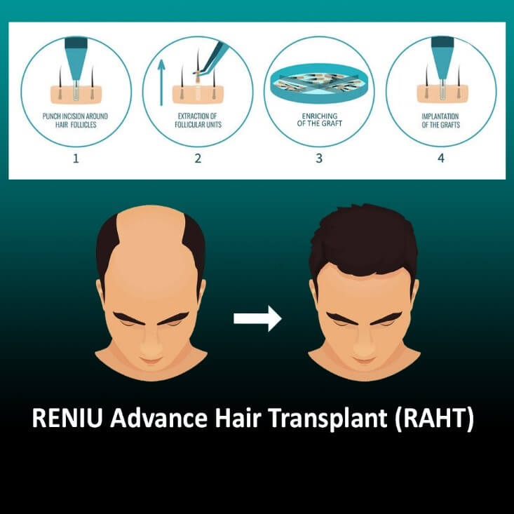 Reniu Advanced Hair Transplant