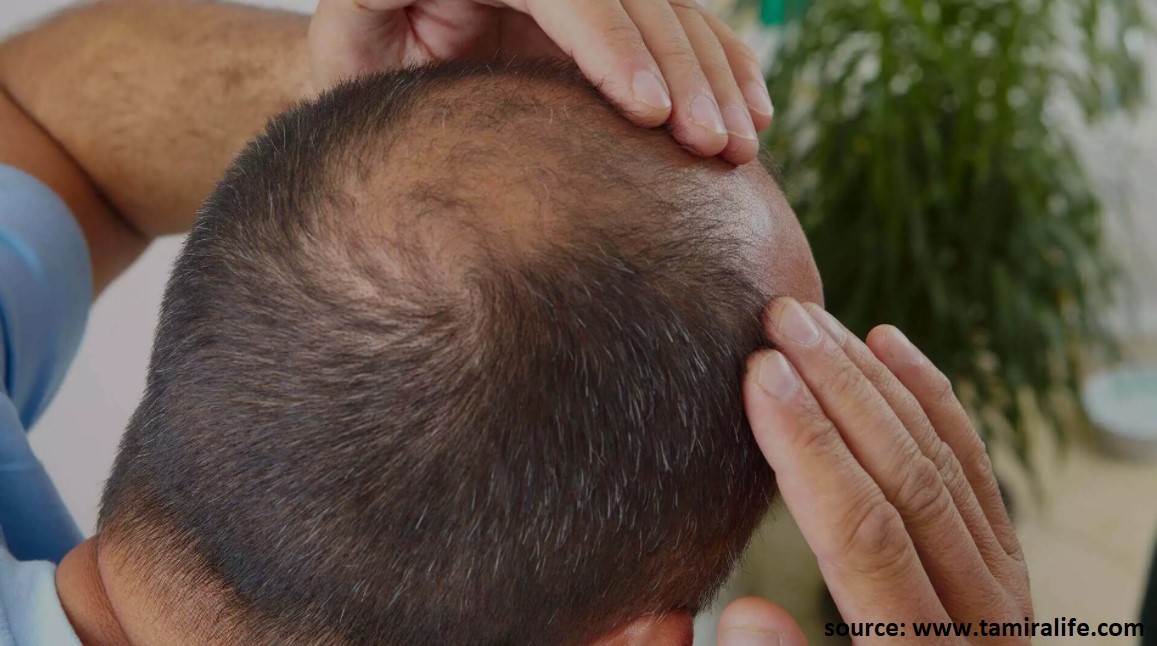 Scabs after a Hair Transplant