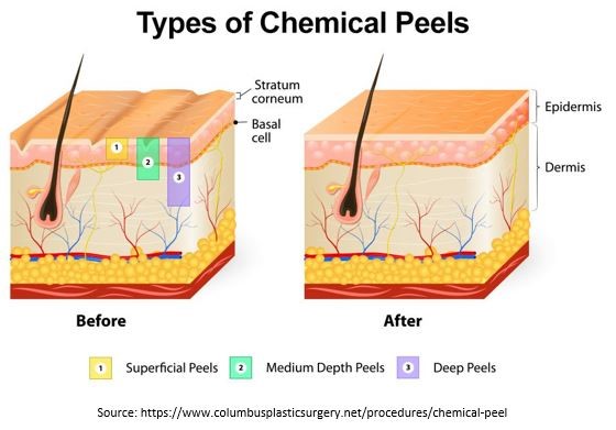 Types of Chemical peels