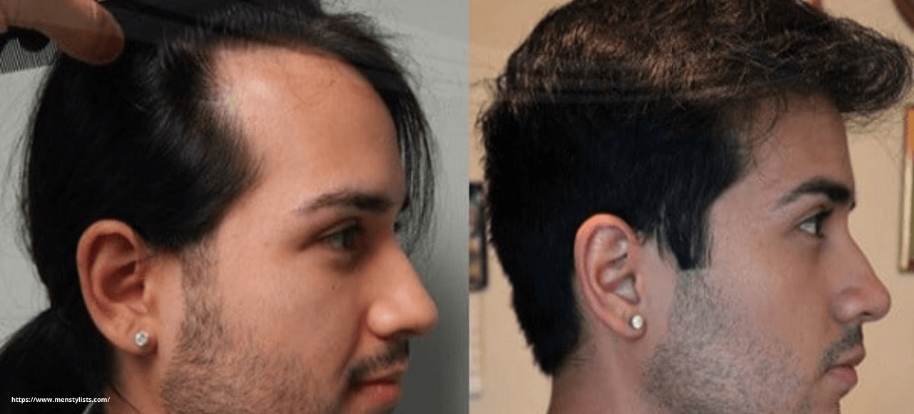 Effect of hair transplant on natural Hair - Reniu Skin, laser, Cosmetolgy & Hair  transplant
