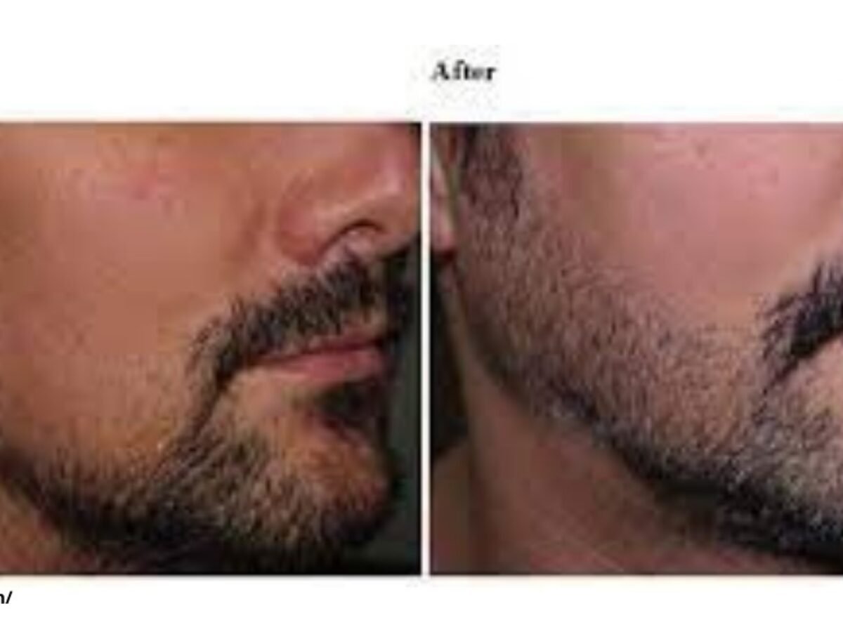 Facial Hair Transplant - Treatment and procedure in Mysore | Reniu Clinic