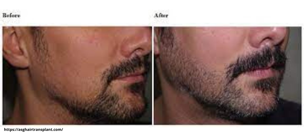 Facial Hair Transplant - Treatment and procedure in Mysore | Reniu Clinic