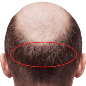 Importance of donor area for hair transplant - Reniu Clinic, Mysore