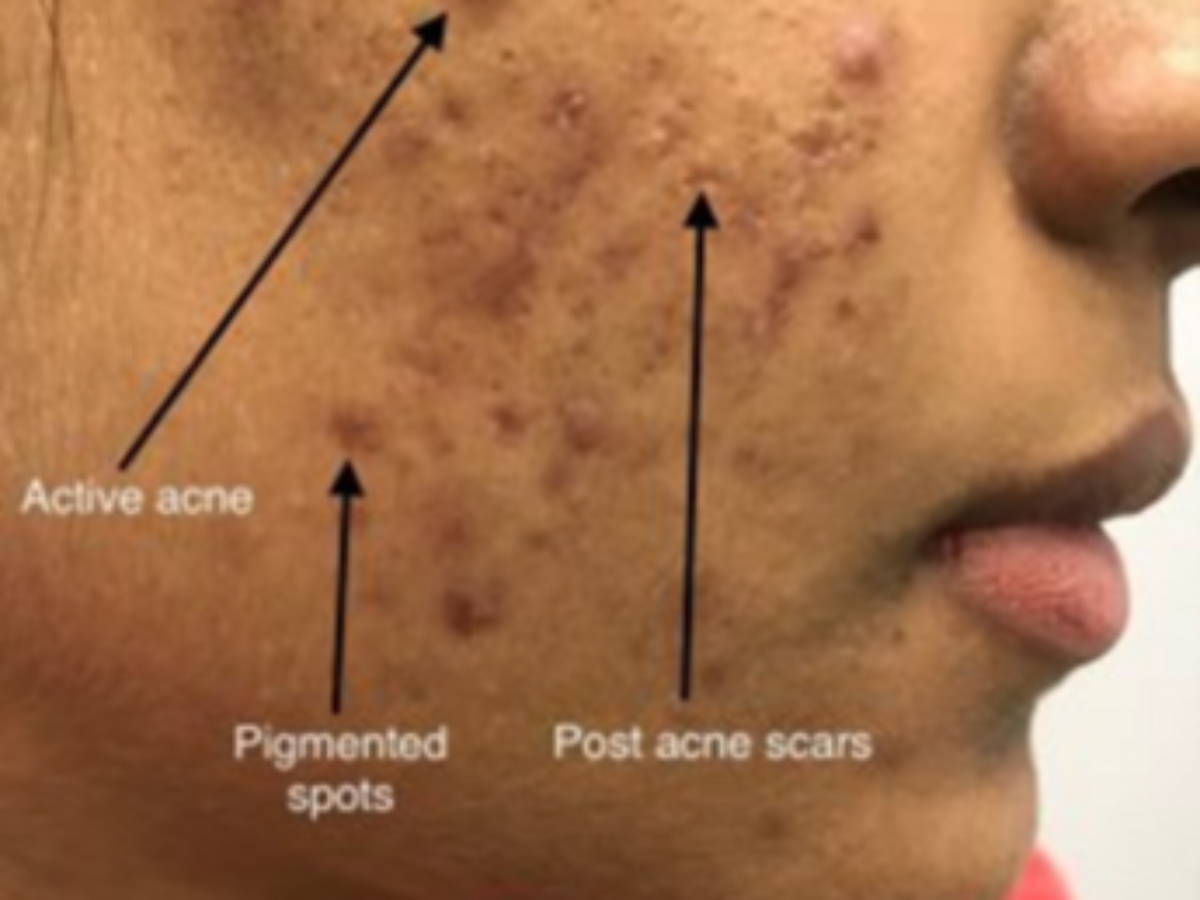 Og hold daytime Kompleks Laser Treatment for Acne Scars in Mysore | Dr. Manas S N
