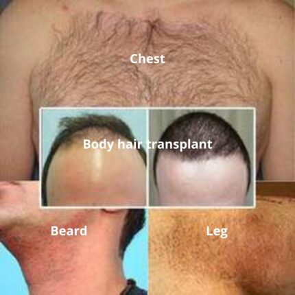 body hair transplant case study