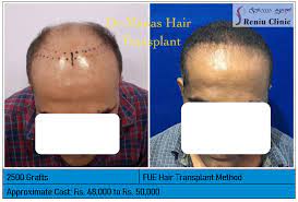 Body hair transplant in Mysore