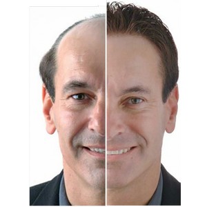 hair transplant image