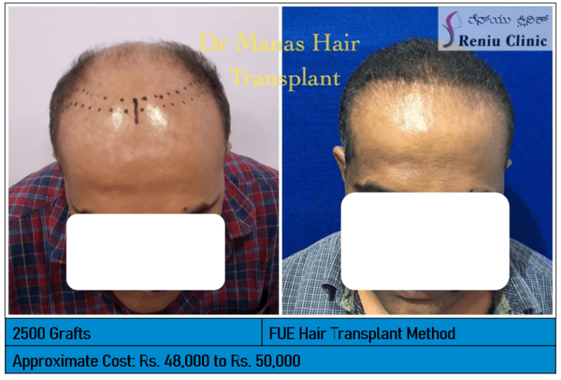 hair transplant images