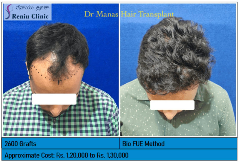Hair transplant Image