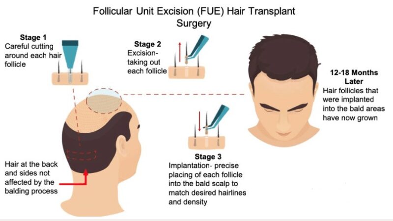 FUE hair transplant
