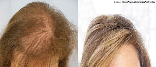 Artificial Hair Fibre Implantation