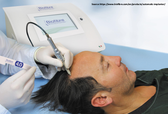 Artificial Hair Fibre Implantation procedure