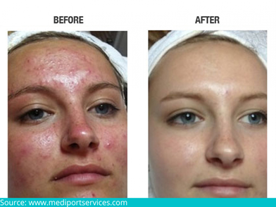 Laser treatment for acne scars results