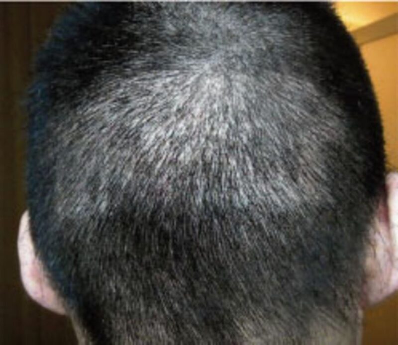 Challenges after hair transplant after 5 years