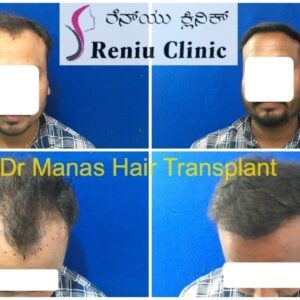 reniu before & after hair transplant
