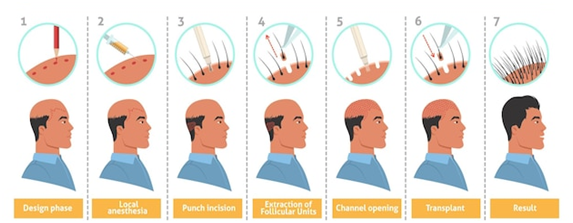 Hair Transplantation Process