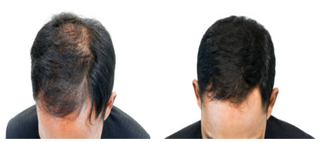 Solution for Diffuse Hair Loss