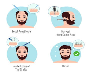 Overview of Hairline Transplant