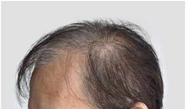 Understanding Diffuse Hair Loss
