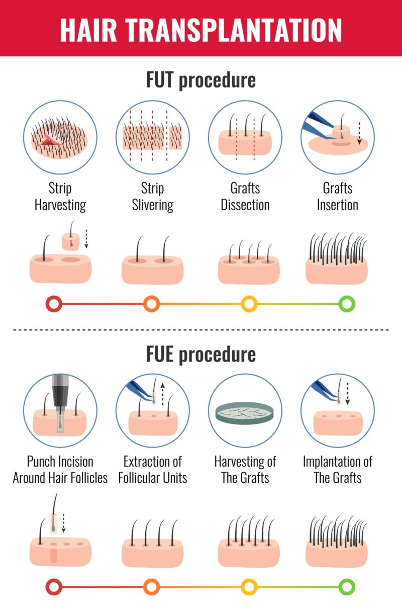 extraction-of-donor-hair