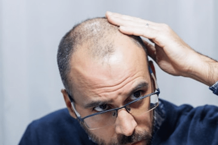 effects-of-scarring-alopecia
