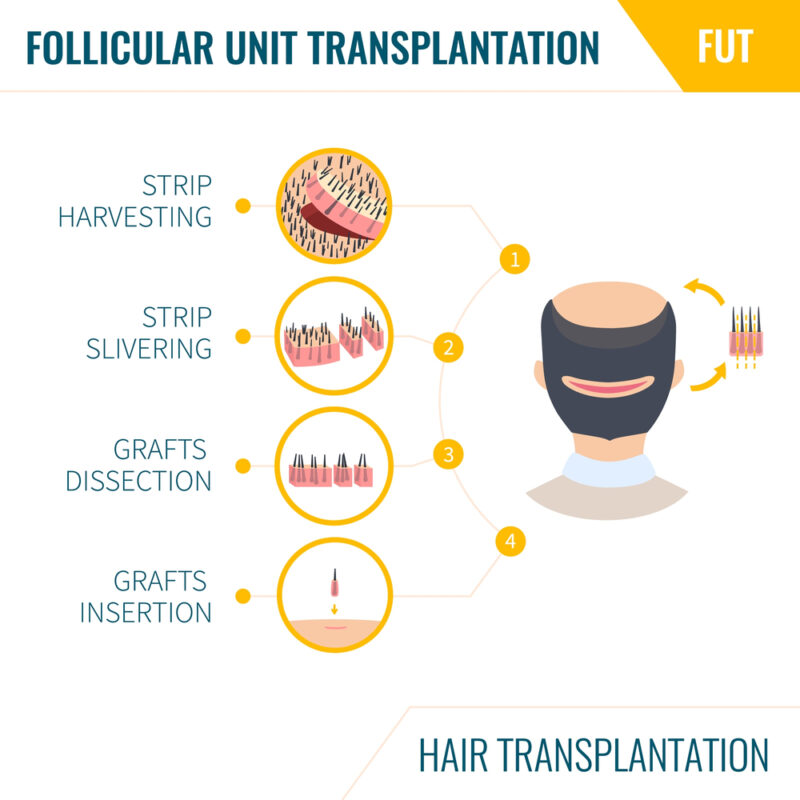 follicular unit transplantation