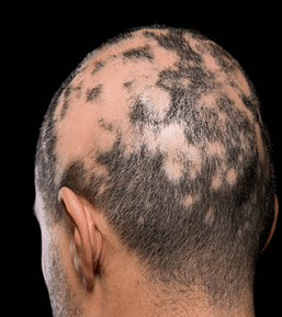 scarring-alopecia-in-mysore