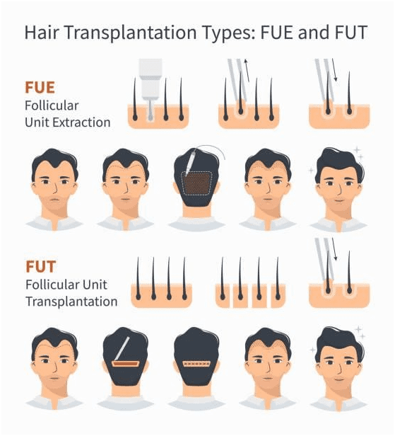 hair-transplantation-types