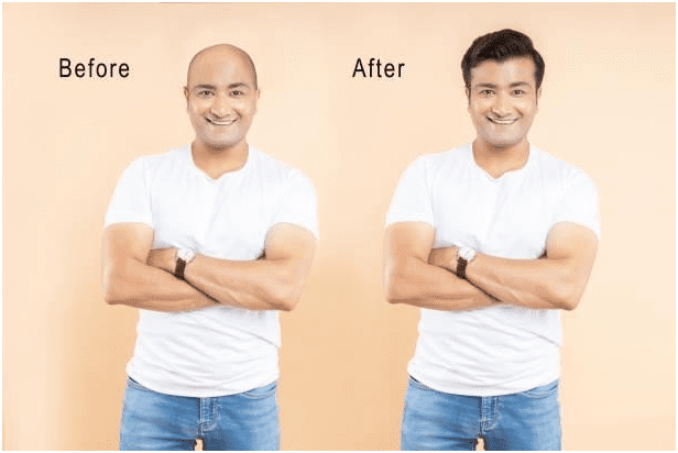 results-after-hair-transplant