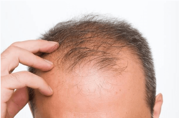 Bio FUE Hair Transplant for Revolutionary Hair Restoration