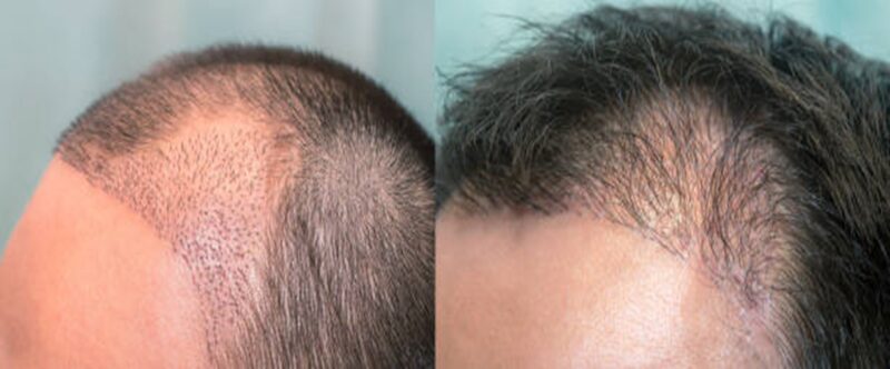 Beyond the Procedure 7 Months After Hair Transplant No Density