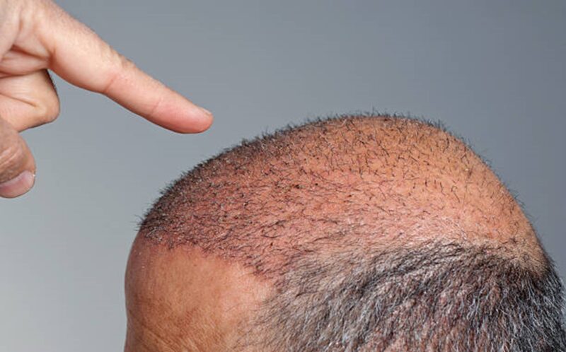 What are the Factors Affecting Hair Transplant Density